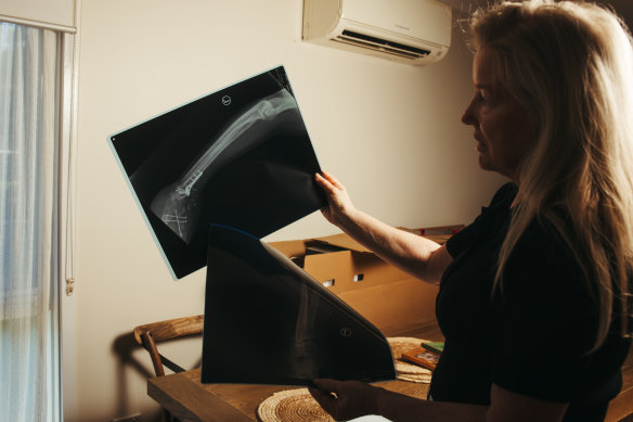 Helen with an X-ray showing some of Drew’s injuries.