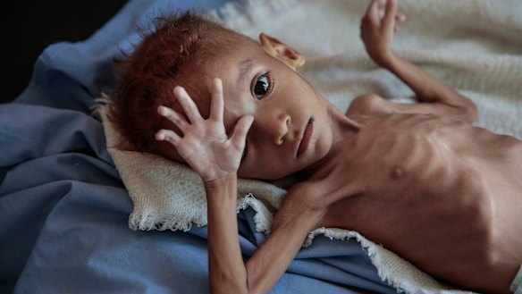 A severely malnourished boy rests on a hospital bed in Hajjah, Yemen. An estimated 85,000 children have died from hunger.