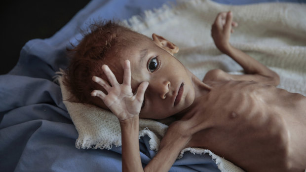 A severely malnourished boy rests on a hospital bed in Hajjah, Yemen. An estimated 85,000 children have died from hunger since the start of the war.