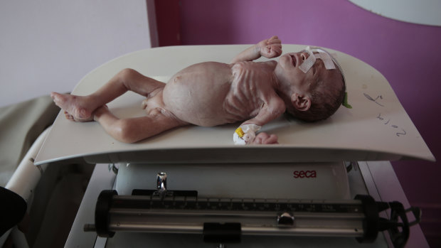 A malnourished boy, Maher Ahmed, is placed on a scale Al-Sabeen hospital in Sanaa, Yemen.