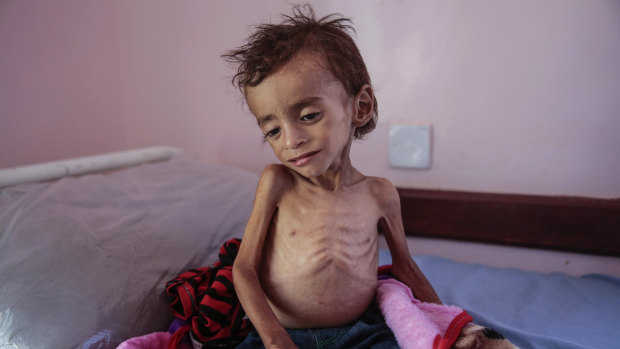 A malnourished boy sits on a hospital bed at the Aslam Health Centre, Hajjah, Yemen, last month.