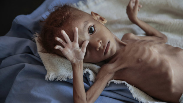 A severely malnourished boy rests on a hospital bed in Hajjah, Yemen. An estimated 85,000 children have died from hunger.