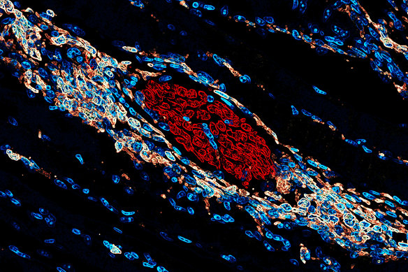 Sensory neurons growing into an injured muscle release a key peptide scientists are trying to harness to boost the body’s wound-healing capabilities.