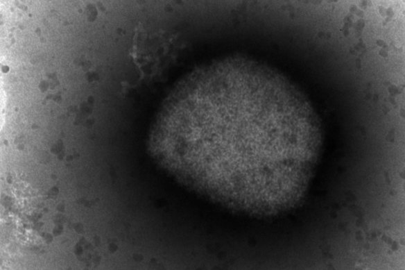 An electronic microscope image shows the monkeypox virus