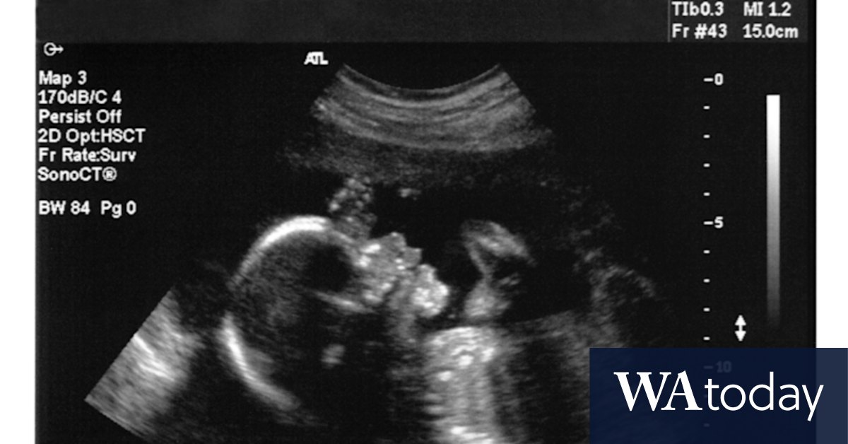 Prenatal genectic tests evoke caution from leading doctors