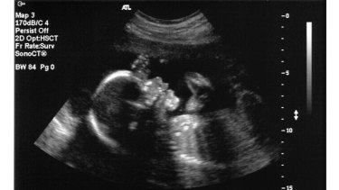 Gender detect when ultrasound can Gender Ultrasound: