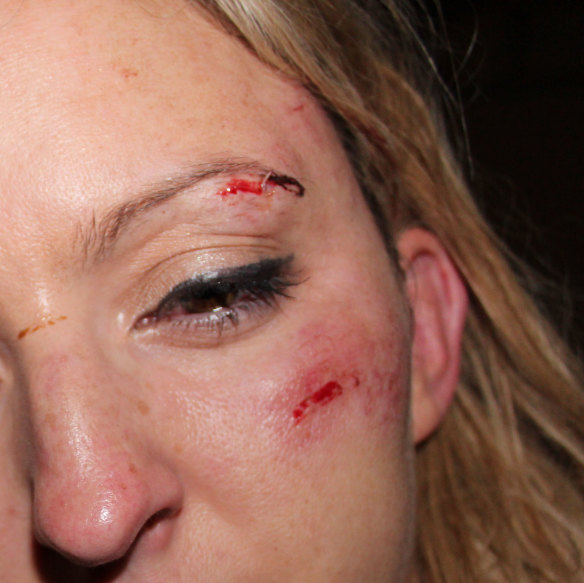 Jessie Scarlett-Rhodes' injuries.