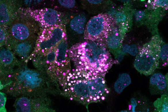 This image shows human liver cells treated with a drug that induces ubiquitin to attach to glucose. The bright white speckles appear where glycogen and ubiquitin overlap, indicating that glycogen has been tagged with ubiquitin inside the cells.