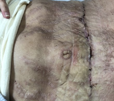 Images of tummy tuck patient Emma