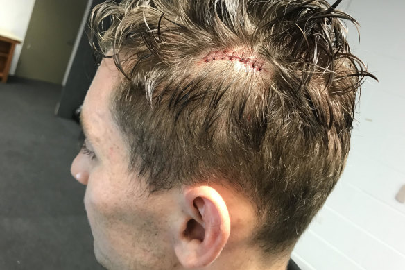 Stitch up ... Cameron Murray needed eight stitched to a nasty head wound.