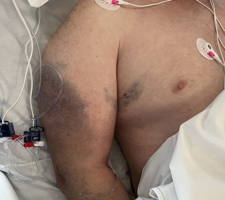 Some of the bruising covering Briggs’ body as he lays in hospital.