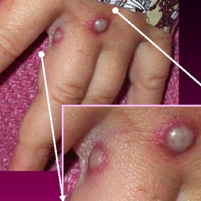 The distinctive monkeypox lesions.