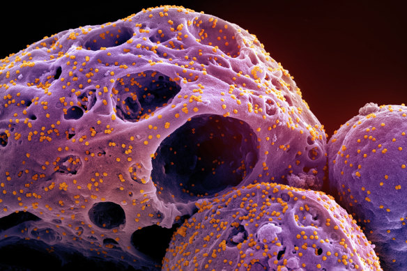 A colourised electron microscope image from the US National Institute of Allergy and Infectious Diseases shows cells (purple) infected with the Omicron strain of COVID-19 (orange).