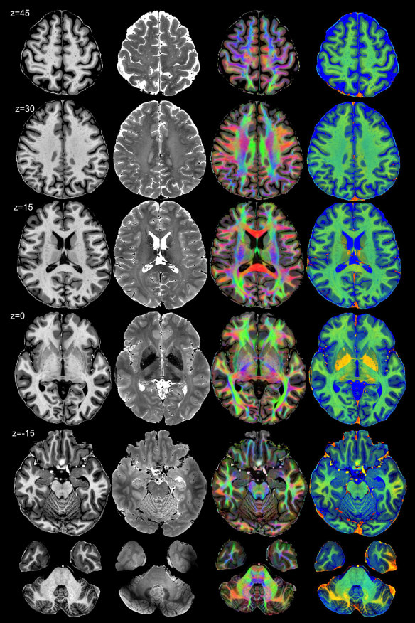 Endorestiform Nucleus: Scientist Just Discovered a New Part of the