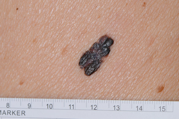 A common type of melanoma.