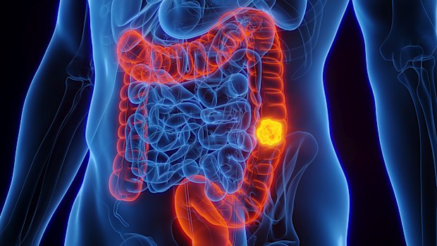Australia has the highest rates of colon cancer in people under 50 in the world.