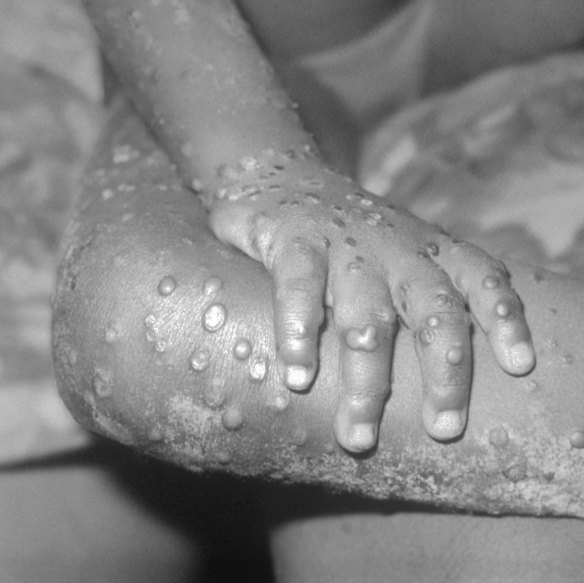 Monkeypox-like lesions on the arm and leg of a girl in Liberia in 1971. 