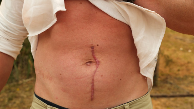 Noll's surgery left him with a large scar.