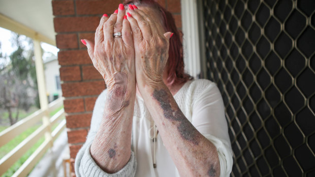 Sue Wheeler was left with badly bruised arms and legs after being attacked by the intruder, while her son sustained a suspected fractured skull. 