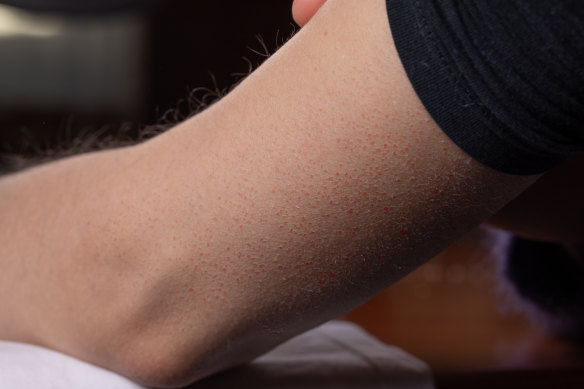 ‘Chicken skin’ on the arms is known as keratosis pilaris.