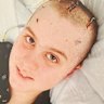 Max Shearer was just 11 years old when doctors discovered a rare form of brain cancer.