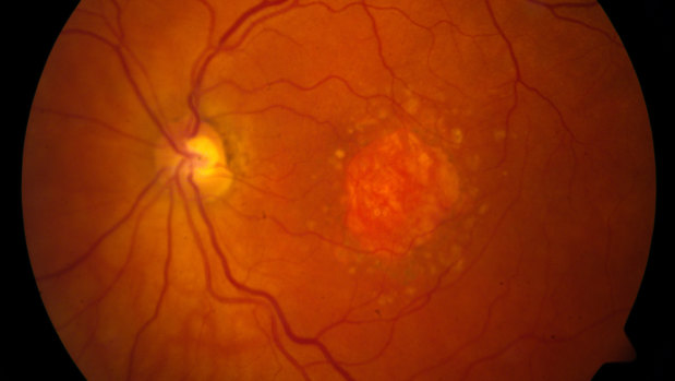 This image shows a microscopic image of a retina being damaged by the so-called 'dry' form of age-related macular degeneration.