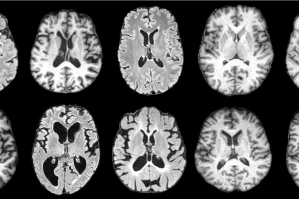 MRI brain scans showing different types of dementia.
