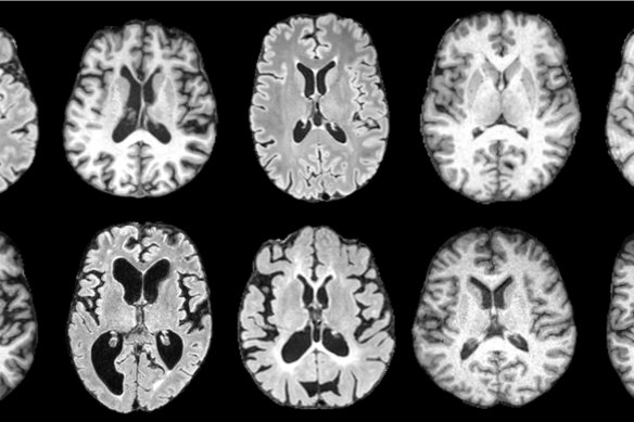 MRI brain scans showing different dementia types.