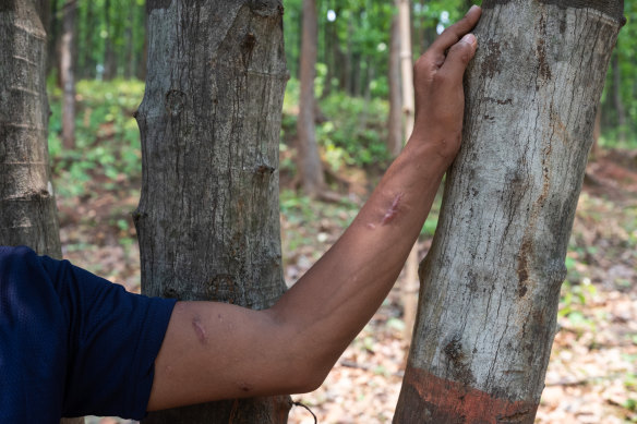 Krishna Bahadur Shahi shows bullet wound scars on his left arm.