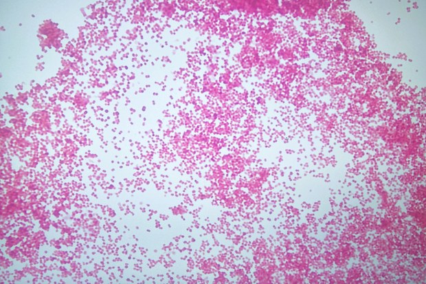 Abundant meningococci bacteria observed, with a notably absence of white blood cells in the spinal fluid from a critically ill meningitis patient.