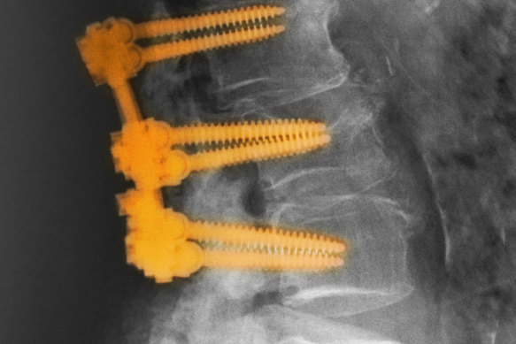 Spinal fusion involves the joining of two or more vertebrae.