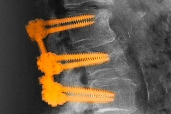Spinal fusion involves the joining of two or more vertebrae.