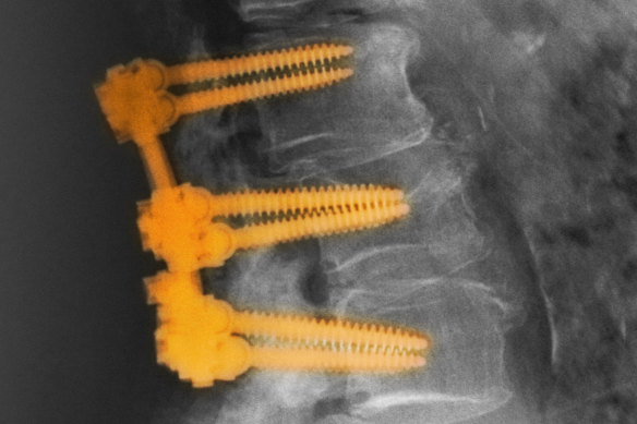 Spinal fusion involves the joining of two or more vertebrae.