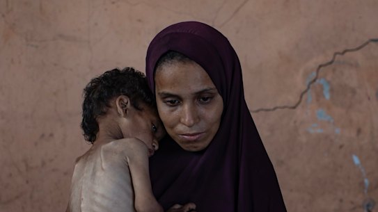 Palestinian child Yazan Abu Foul, 2, who is suffering from severe malnutrition, is held by his mother, Naima.
