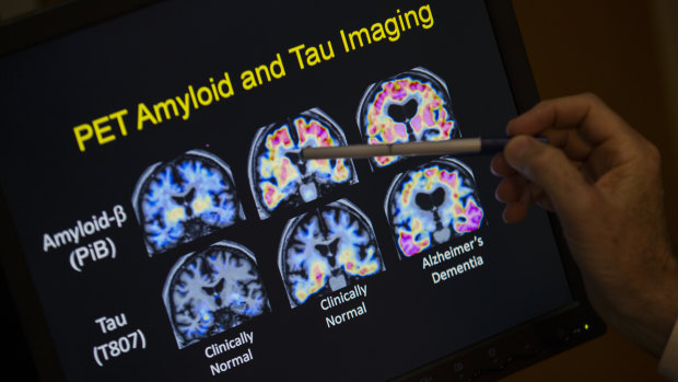 PET scan results in a study on Alzheimer's disease.