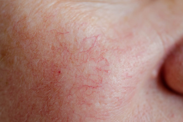 Spider veins often appear on the face, but can occur anywhere on the body.