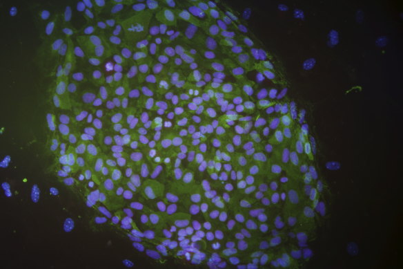 Induced pluripotent stem (iPS) cell used in stem cell research.