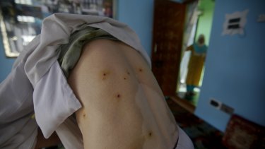 Kashmiri youth Gulam Rasool Bhat shows pellet wounds on his body in Srinagar, Indian controlled Kashmir.