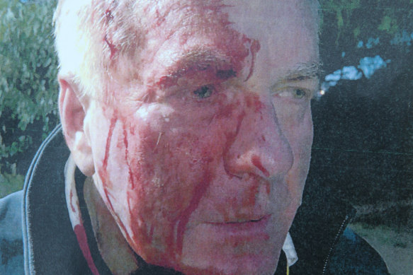 Chris O'Neill after the attack by the Stephens brothers.