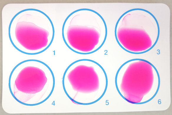 Rose Bengal dye reacts with a laser light to trigger a blood clot in the brain.