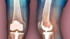An X-ray of a 69-year-old’s knees after a total knee replacement. Exercise could help you avoid one.