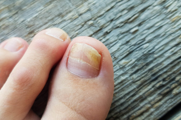 Fungal nail infections are being linked to poor hygiene practices at beauty salons.