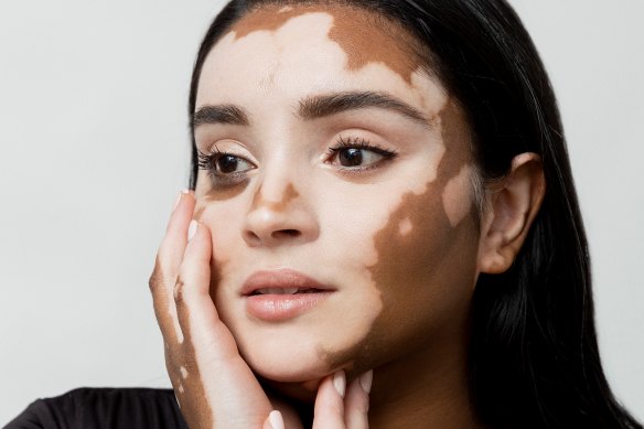 Model Onela Muralidharan hopes to raise awareness for conditions like vitiligo.  