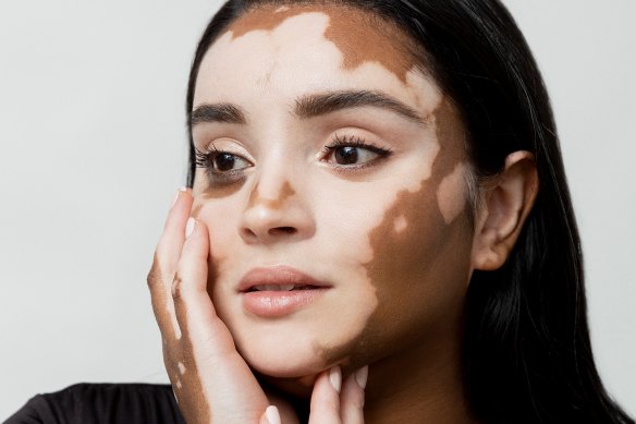 Model Onella Muralidharan wants there to be greater awareness of conditions like vitiligo.  