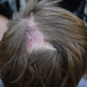 Dog attack victim Jack Hartigan shows the injuries to his scalp. 