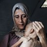 Muhammad Zakariya Ayyoub al-Matouq, 1, is facing life-threatening malnutrition.
