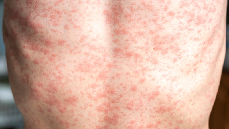 Measles risk rises for Sydney as more cases detected