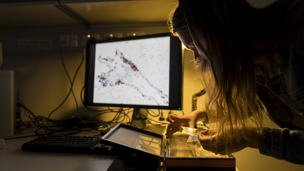 A researcher examines a slide with brain tissue from a person with schizophrenia.