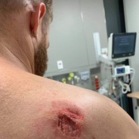 A security worker at Port Macquarie Base Hospital suffered a deep bite wound to his shoulder during a violent assault on staff last month. 