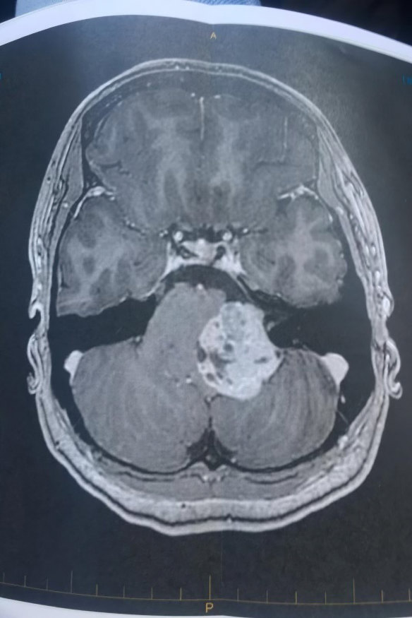 A scan showing a meningioma. 